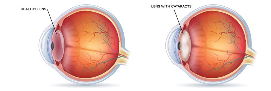 Cataract Eye Treatment for Adults