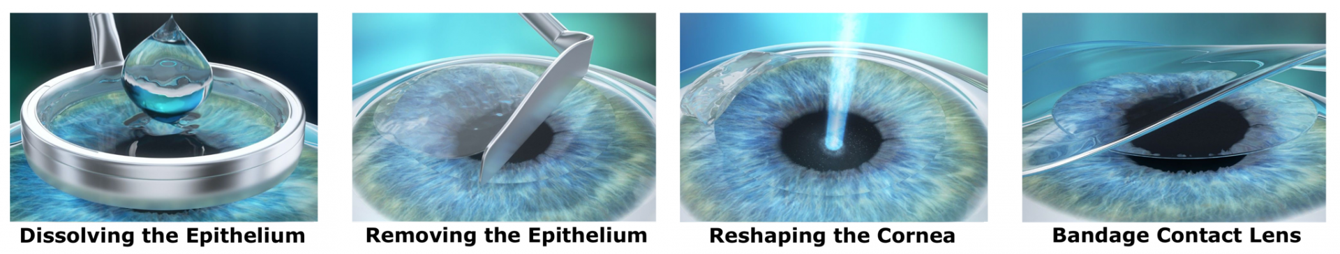 Photo-Refractive Keratectomy (PRK)