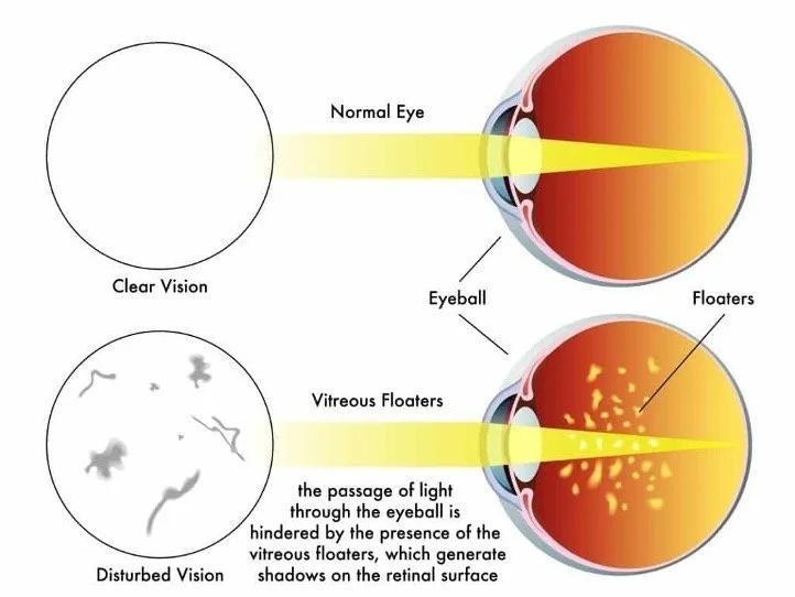 Retinal Detachment: Understanding the Risks, Warning Signs, and the Importance of Early Treatment